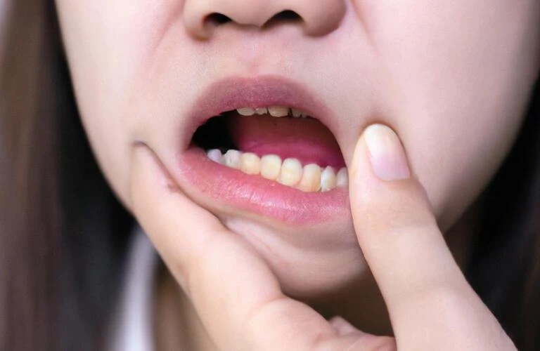 口内炎にさよなら！あなたの健康な口腔を取り戻しましょう！｜鶴瀬の歯医者・うららか歯科